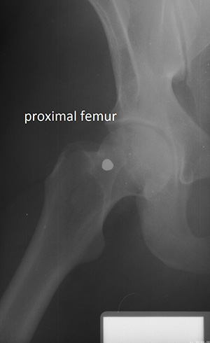 X-ray of a proximal femur. Image courtesy of Ann Ross. Click to enlarge.