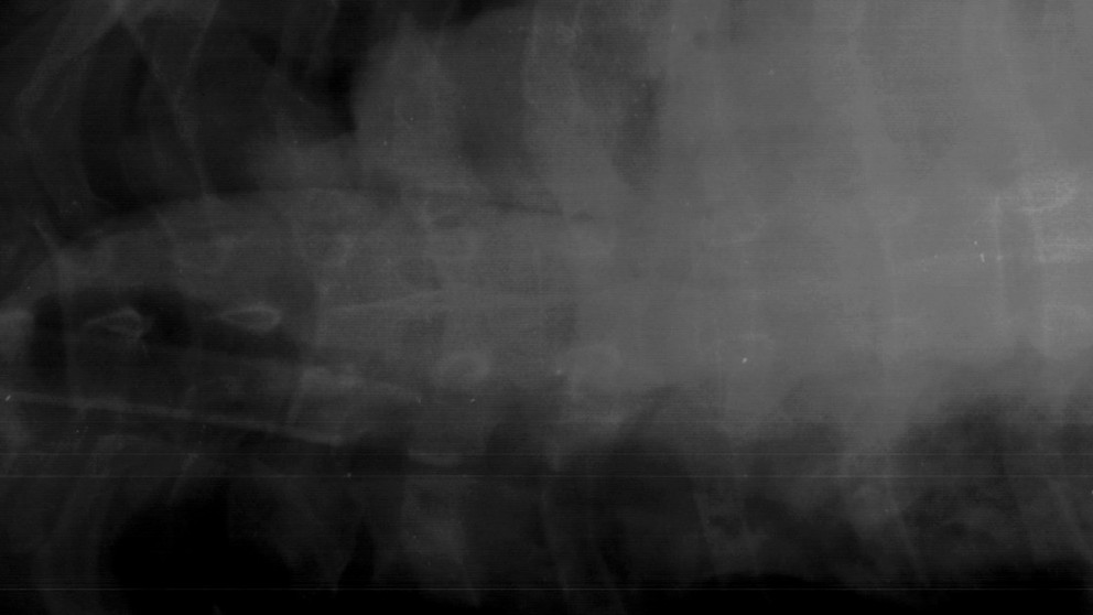X-ray of lumbar vertebrae. Image courtesy of Ann Ross.