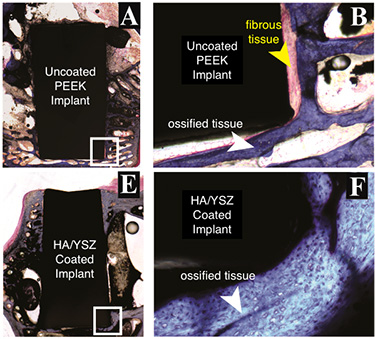 Histological evaluation of bone growth against the non-coated PEEK implants (A and B) and coated PEEK implant using our Ion Beam Assisted Deposition followed by the  Microwave heat treatment and a final autoclaving (E and F) after 18 weeks of implantation in a rabbit model. The new bone in contact with the implant surface appeared to be much thinner in the uncoated PEEK group at 18 weeks (B) compared to the new bone formed in contact with the (F) coated implants at the same time. White arrow point at ossified (Indicating new bone formation) and yellow arrow point at the fibrous tissue (indicating scar-like tissue), implant marked by “I”.  Click to enlarge.