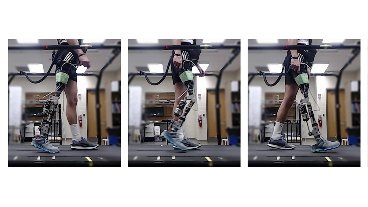 person with prosthetic leg walking on treadmill