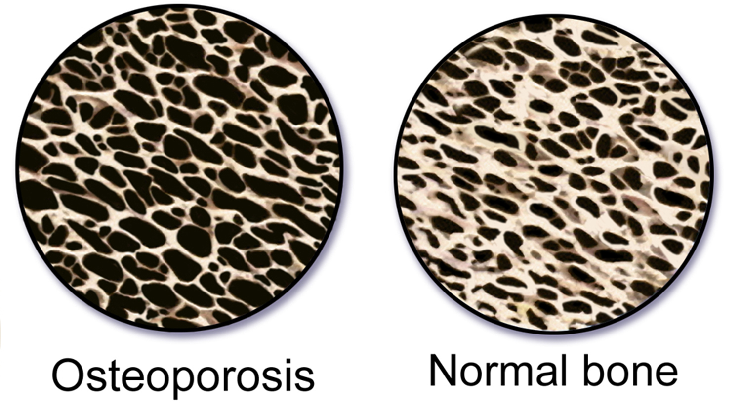 graphic of bone with osteoporosis compared to normal bone
