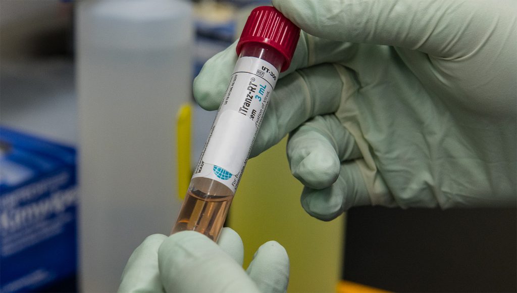 A test tube containing a patient’s sample to be tested for the presence of SARS-CoV-2, the virus that causes COVID-19.