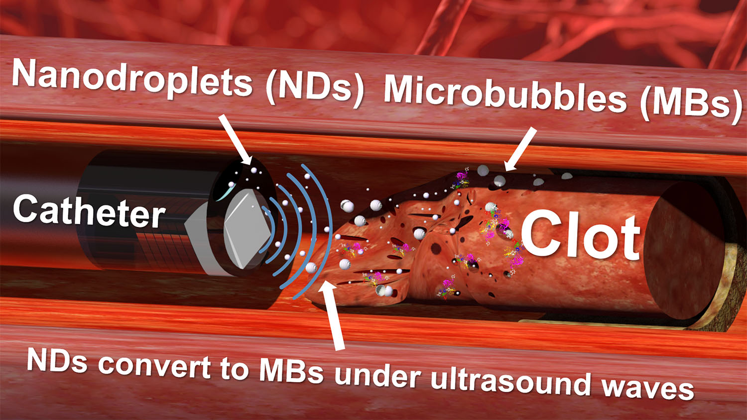 Diagram of the nanodroplet and ultrasound drill at work.