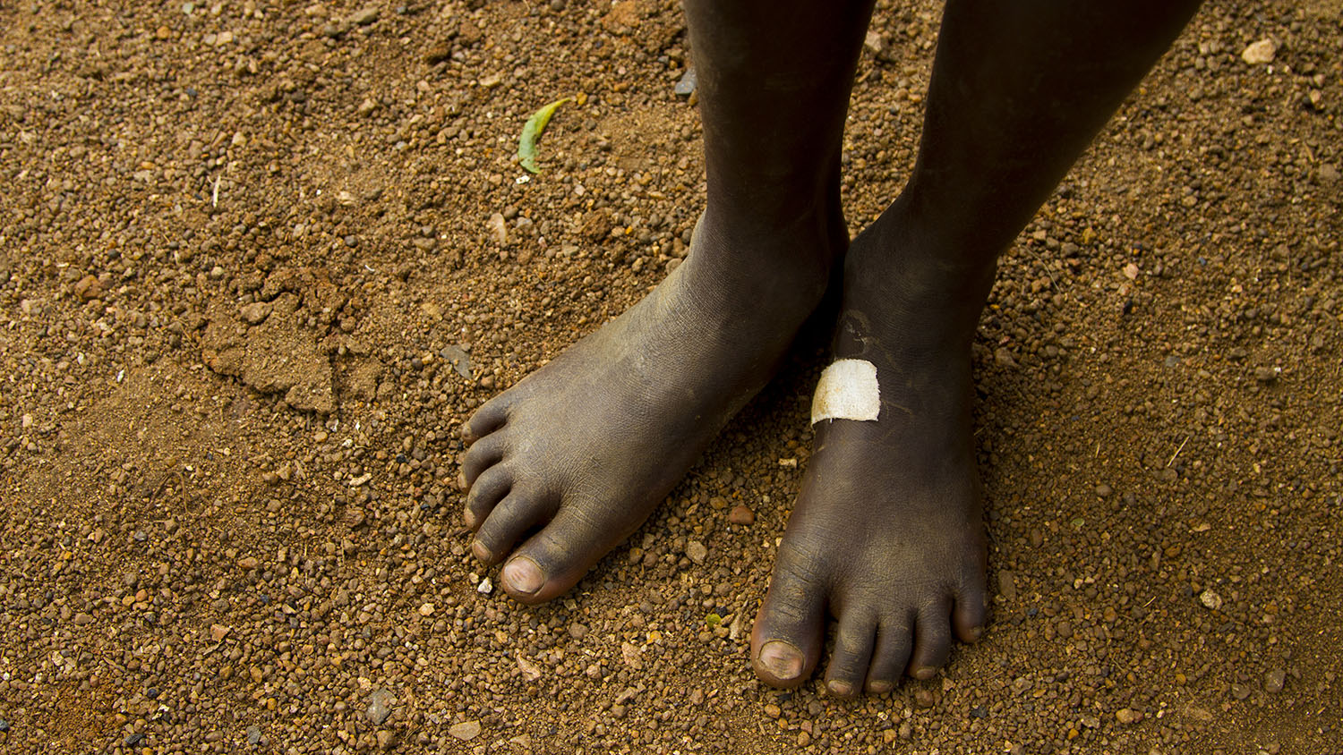 Child's feet, with one foot bandaged.