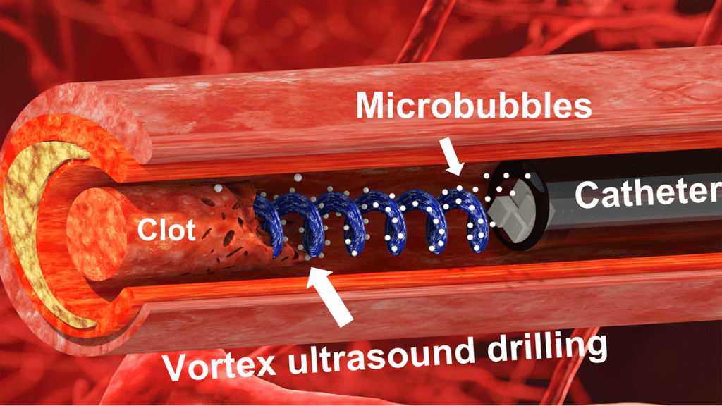 Illustration shows cross-section of a clogged blood vessel, with blue lines representing the vortex ultrasound clearing the clot