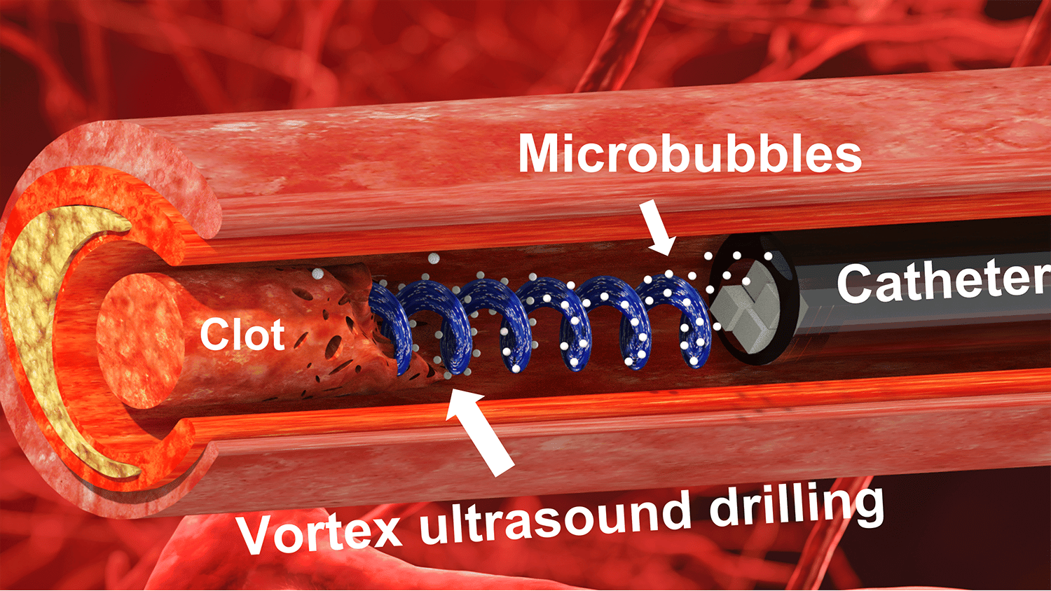 illustration shows cross-section of a clogged blood vessel, with blue lines representing the vortex ultrasound clearing the clot